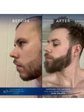 Beard Transplant - WestModern Clinic