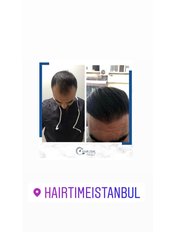 Saphir Haartransplantation - Hair Time Istanbul