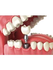 Dental Implants - Medicaleste