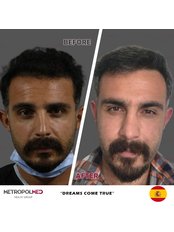 Manuel FUE - Metropol Med Hair Transplant