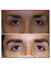 Eyebrow Transplant - Metropol Med Hair Transplant
