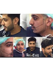 Beard Transplant - Metropol Med Hair Transplant