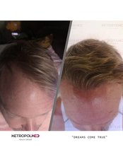 Sapphire Hair Transplant - Metropol Med Hair Transplant
