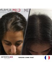 Treatment for Female Pattern Hair Loss - Metropol Med Hair Transplant