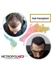 DHI - Direct Hair Implantation - Metropol Med Hair Transplant