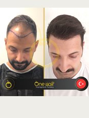 One Hair Clinic - Before / After