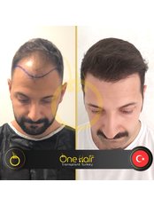 One Hair Clinic - Before / After 