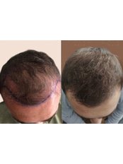 Sapphire Hair Transplant - Prive Hair Clinic