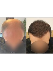 Hair Transplant - Your Medical Guide in Istanbul
