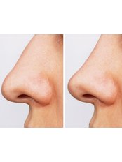 Rhinoplasty - Your Medical Guide in Istanbul