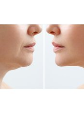 Facelift - Your Medical Guide in Istanbul