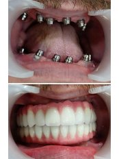 All-on-6 Dental Implants - CLINIQUEPLUS