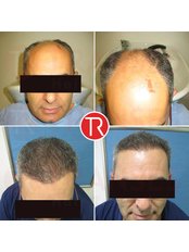 FUE - Follicular Unit Extraction - Transes Hair Transplant