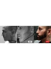 Beard Transplant - Transes Hair Transplant
