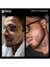 Beard Transplant - Alana Clinic