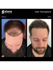 Sapphire Hair Transplant - Alana Clinic