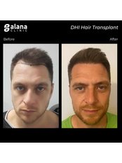 DHI - Direct Hair Implantation - Alana Clinic