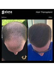 Sapphire Hair Transplant - Alana Clinic