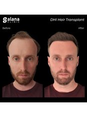 DHI - Direct Hair Implantation - Alana Clinic