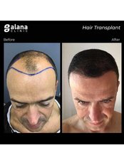 Hair Transplant - Alana Clinic