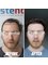 Estenbul Health - Hair Transplant Turkey Before and After 