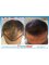 Estenbul Health - Hair Transplant Turkey Before and After 