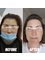 Estenbul Health - Woman Hair Transplant Turkey Before and After 