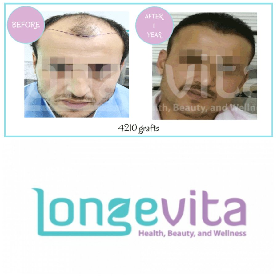 Longevita Hair Transplant - Istanbul, Turkey • Read 2 Reviews