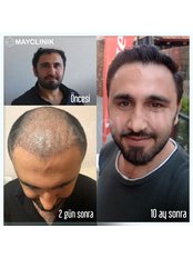 Hair Transplant - MayClinik Hair Transplant