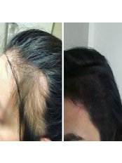 Treatment for Female Pattern Hair Loss - Ahmet AYIK MD.