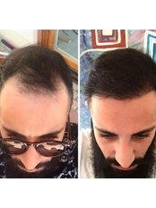 Hair Transplant - Ahmet AYIK MD.