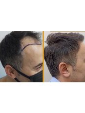 Hair Transplant - Dr. Abdullah Unal