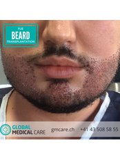 Beard Transplant - Global Medical Care - Hair Transplant - Istanbul