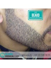 Beard Transplant - Global Medical Care - Hair Transplant - Istanbul