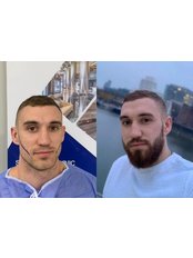 Beard Transplant - İstanbul Hair Lab