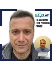 Hair Transplant - İstanbul Hair Lab