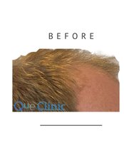 Hair Transplant - QueHairClinic