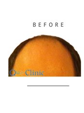 SignatureStrands Custom Hair Restoration - QueHairClinic