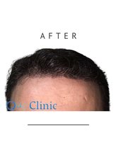 SignatureStrands Custom Hair Restoration - QueHairClinic