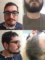  Beard Transplant with DHI Technique and Painless Anesthesia - World Plast Hair Center