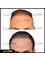 Essi Hair Transplant Clinic - Before&After 