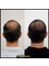 Essi Hair Transplant Clinic - Before&After 