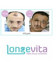 Longevita Hair Transplant - Izmir - Cemal Gursel Caddesi No: 248, Daire: 2 Karsiyaka, Izmir, www.longevita.co.uk,  0