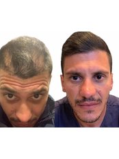 Hair Transplant - RS Perfection Clinic