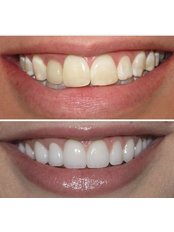Teeth Whitening - Este Medical Group Bristol Ltd