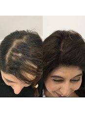 Treatment for Female Pattern Hair Loss - Este Medical Group Bristol Ltd