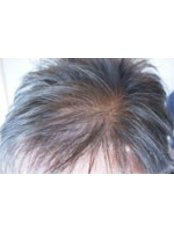 Hair Loss Treatment - Hairology