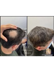 Bald Spot Removal - Hair Loss Clinic - Chester & Wirral