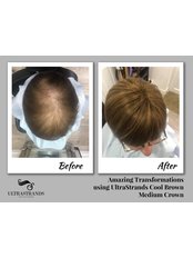Hair Loss Specialist Consultation - UltraStrands Hair Volumising Systems