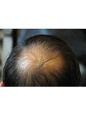 Hair Loss Specialist Consultation - Stockport Hair Loss Clinic